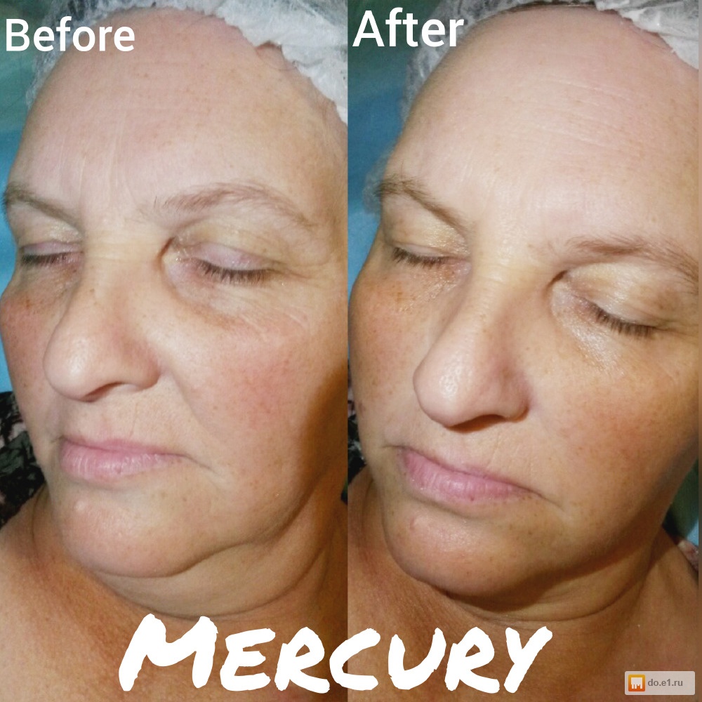 лазерная шлифовка шеи и декольте. газожидкостный пилинг jet peel. Jet peel аппарат газожидкостный пилинг. маска для зоны декольте. скульптурный массаж лица.